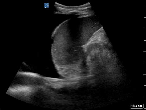 Pleural Effusion On Point Of Care Ultrasound Pocus Image