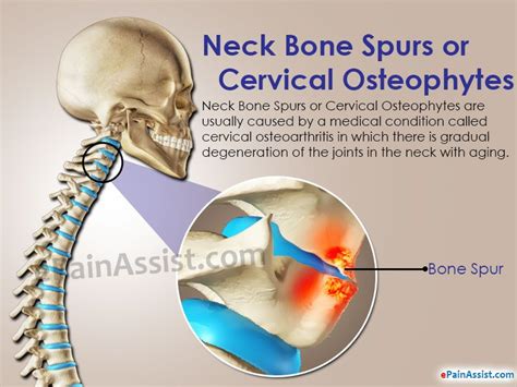Pin On Bone Spurs In The Neck