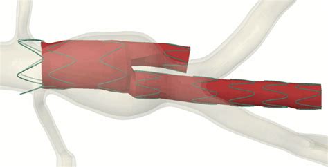 Stent Based Treatment For Aortic Dissections — Institute Of Biomedical