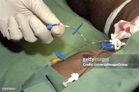 Central Venous Catheter Insertion The Surgeon Holds The Blue Port