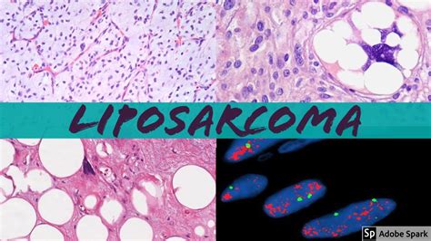 Liposarcoma 101 Everything A Pathologist Needs To Know Youtube