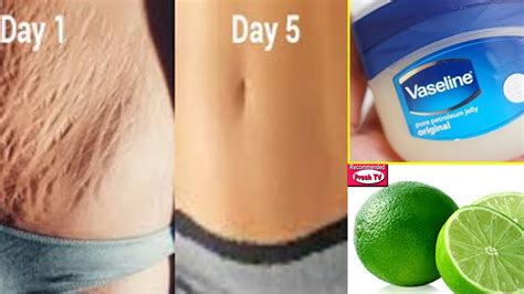 How To Get Rid Stretch Marks Fast Naturally And Permanently At Home In