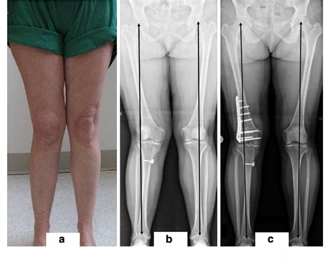 Pdf The Effect Of Lateral Opening Wedge Distal Femoral Osteotomy On