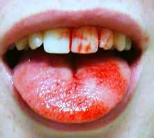 Sangre en la boca (2016) trailer. Clínica SMART dental: EL PIERCING ORAL Y SUS CONSECUENCIAS