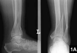 The two bones help to stabilize and support the ankle and lower leg muscles. Surgical Treatment of Distal Tibia Fractures: A Comparison ...