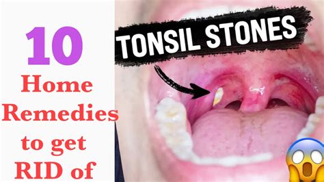 Tonsil Stones What Causes Them And 10 Home Remedies To Get Rid Of Them