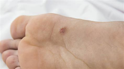 Plantar Warts Treatment And Causes