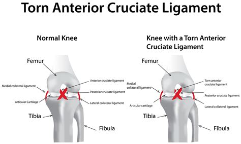 Anterior Cruciate Ligament Acl Injury Causes Symptoms Diagnosis Hot