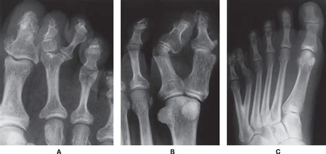 6 Normal Variants And Anomalies Musculoskeletal Key