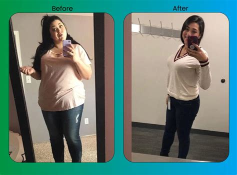 Low Bmi Gastric Sleeve Before And After Results Pictures International Clinics