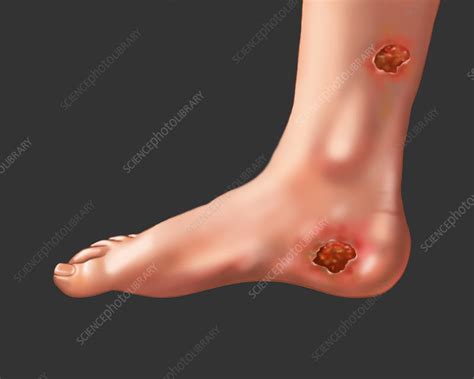 Bed Sores Stock Image F0316991 Science Photo Library