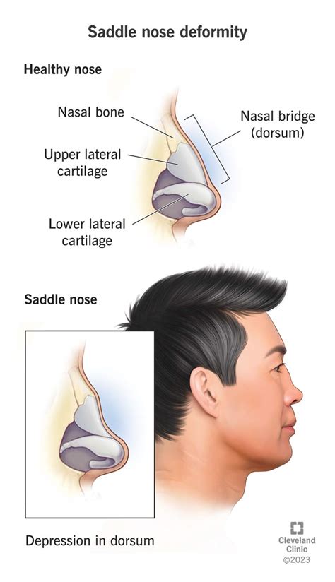 What Is A Saddle Nose Deformity
