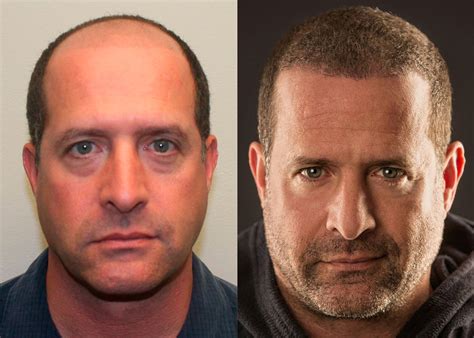 Hair transplant is the method of transplanting your hair's results of hair transplant surgery are fantastic. Nothing Beats Restoring Your Natural Hair / Low Density ...