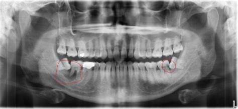 Wisdom Teeth Faq Temecula Dental Implants And Oral Surgery
