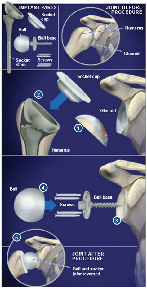 Reverse Total Shoulder Replacement Central Coast Orthopedic Medical Group