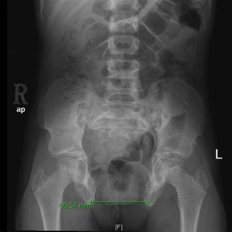 Immediate Postoperative Anteroposterior Radiograph Of The Pelvis