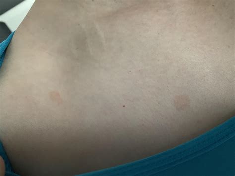 Any Idea What The Heck These Spots Could Be On My Chest Area About