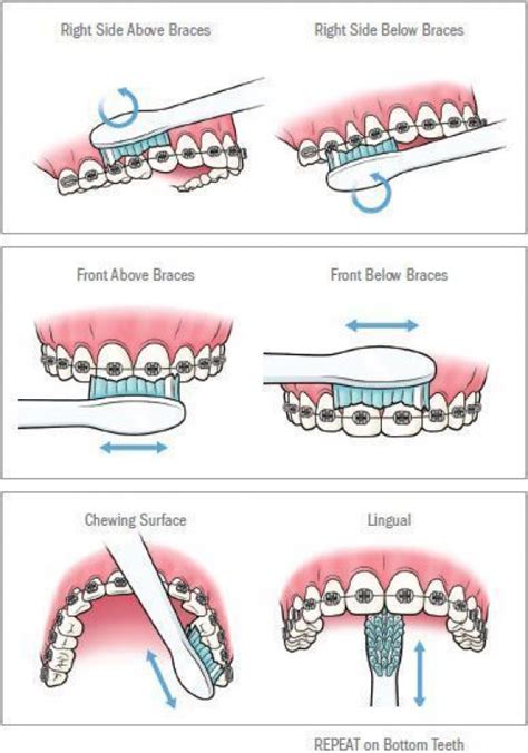 Pin By 𝚈𝚞𝚌𝚔𝚢𝚃𝚑𝚎𝙳𝚞𝚌𝚔𝚢 On Getting Braces In 2020 Braces Tips Oral Hygiene Getting Braces