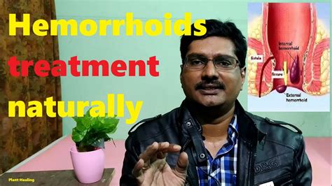 Hemorrhoids Piles Fissures Fistula Causes And Natural Healing