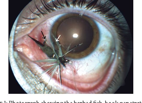 Figure 1 From Penetrating Fish Hook Ocular Injury Management Of An