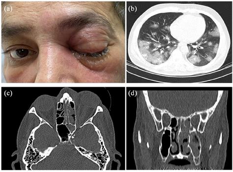 Rhino Orbital Mucormycosis During Steroid Therapy In Covid Patients