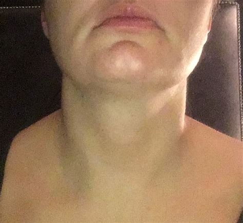 Is This Goiter Would You Say This Shows Goiter Thyroid Uk