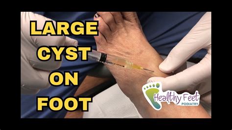 Monster Foot Cyst Drained Ganglionic Cyst Being Drained Youtube