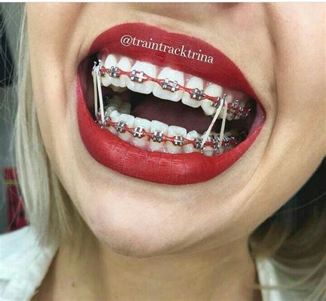Braces Colors For Girls Teeth Photos Cantik