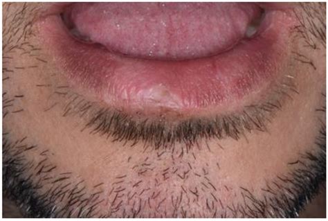 Actinic Cheilitis Affecting The Lower Lip With Pallor And Blurring Of
