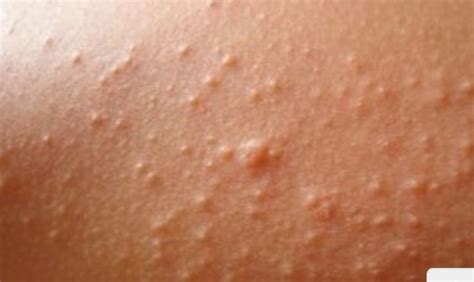 Non Itchy Rash Red Spots On Skin Causes And Treatment Itchy Rash