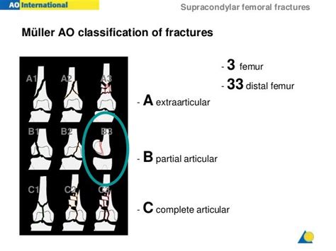 Ao Classification Femur Fracture