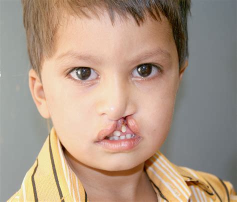 Cleft Lip Surgery Before And After