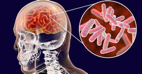 Cum Sa Stii Ca Ai O Bacterie Sau O Ciuperca In Creier Simptome Si Riscuri Discard