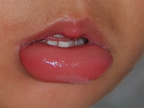 Gonflement de la lèvre supérieure ou inférieure: causes ...