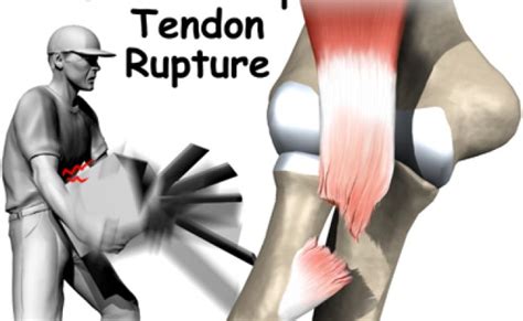 Distal Biceps Rupture Bouldercentre For Orthopedics Spine Otosection