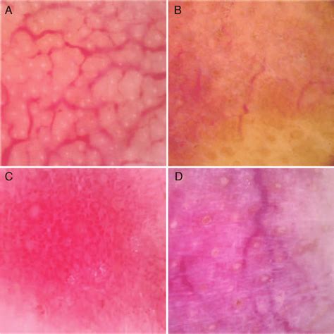Common Vessels Of Rosacea In Dermoscopy A Reticular Linear Vessels