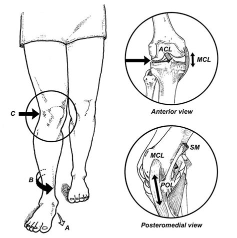 Pes Anserine Bursitis A Pain In The Knee Physiohealth