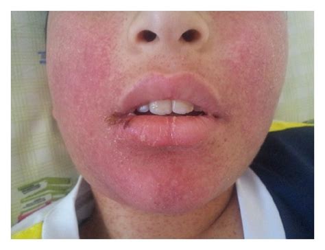 Generalised Maculopapular Rash Partly Confluent To Plaques On Face