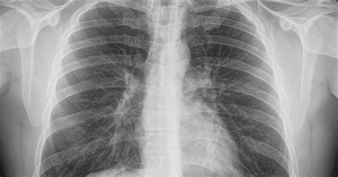 Zwapnienia w płucach co to jest Przyczyny schorzenia TVN Zdrowie TVN Zdrowie