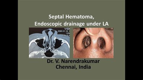 Septal Hematoma Endoscopic Drainage Under La Dr V Narendrakumar