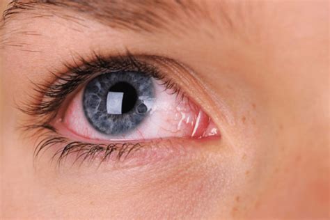 Allergic Conjunctivits How To Manage Red Itchy Eyes Book An Eye Test