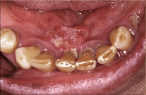 Squamous Cell Carcinoma Of The Floor Of The Mouth In Condition Of Poor