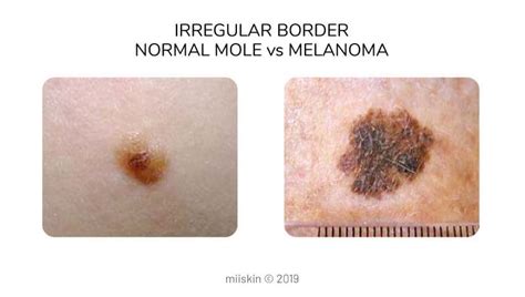 Melanoma Pictures Skin Melanomas Vs Non Cancerous Moles Hot Sex Picture