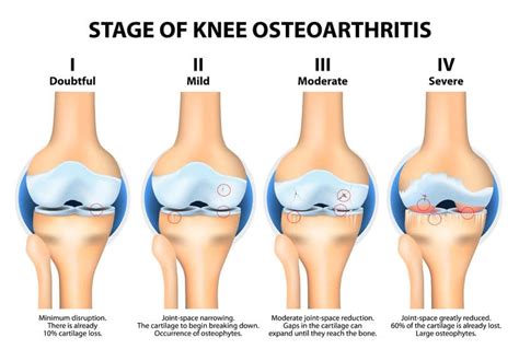 The inflammatory cycle starts with an injury. 5 Most Common Causes of Knee Pain - The Well Theory