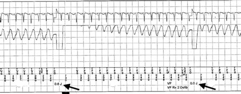 Electrogram Of Ventricular Fibrillation Episode Arrows Denote Two