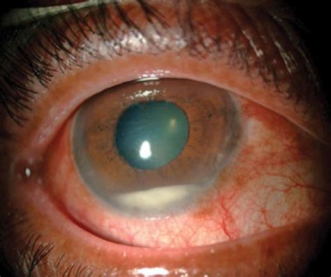 What Causes Swelling In The Eye After Cataract Surgery