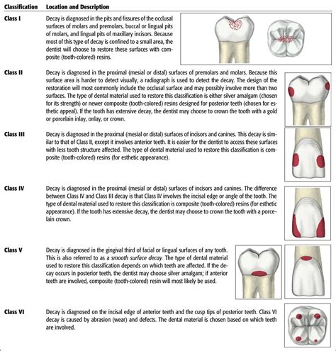 Dental Caries Classification System
