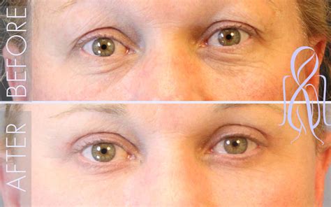 Lower Eyelid Lift Blepharoplasty Eyelid Surgery In Atlanta Ga