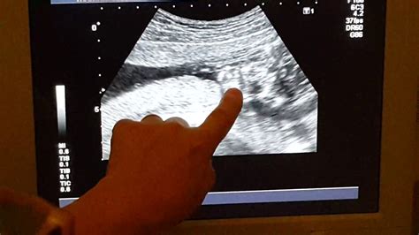 ecografia de 4 meses de embarazo niña ️ ️ ️ youtube
