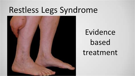 Restless Leg Syndrome Evidence Based Treatment Youtube